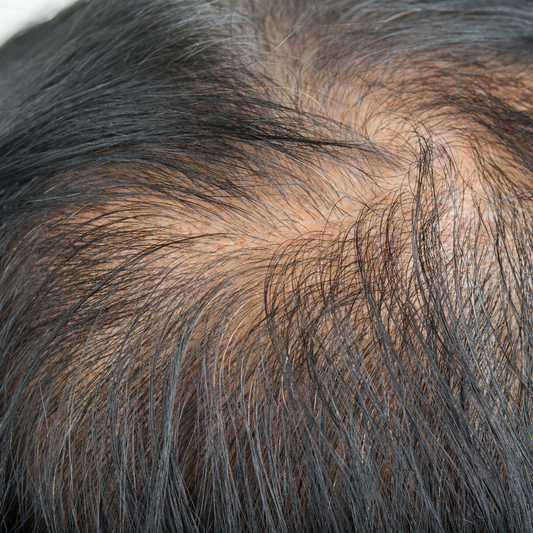 薄くなった頭頂部